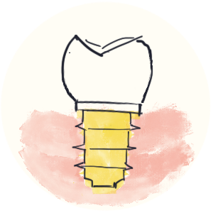 Ma Clinique Dentaire Rive implant